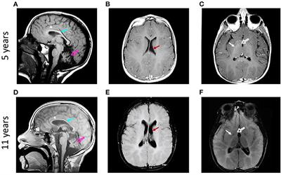 Longitudinal Evaluation of Cerebellar Signs of H-ABC Tubulinopathy in a Patient and in the taiep Model